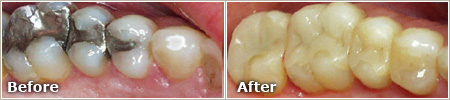 teeth with large silver fillings before treatment and natural looking tooth-colored restorations after treatment