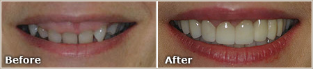 gapped and misshapen teeth before treatment, evenly spaced teeth after treatment