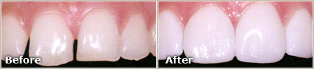 gapped and slightly misshapen teeth before veneers, even and white teeth after veneers