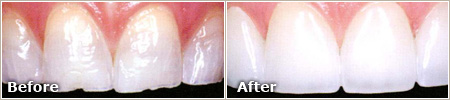 slightly damaged teeth before treatment, white and restored teeth after treatment
